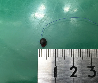 黒色腫　切除した腫瘤